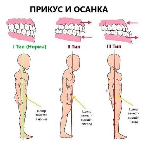 Иллюстрация 20 из исходной статьи о брекетах
